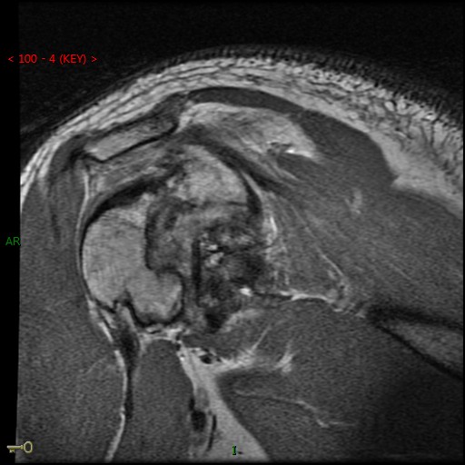 Figure 3 for case Chronic posterior glenohumeral dislocation ( RID4770 )